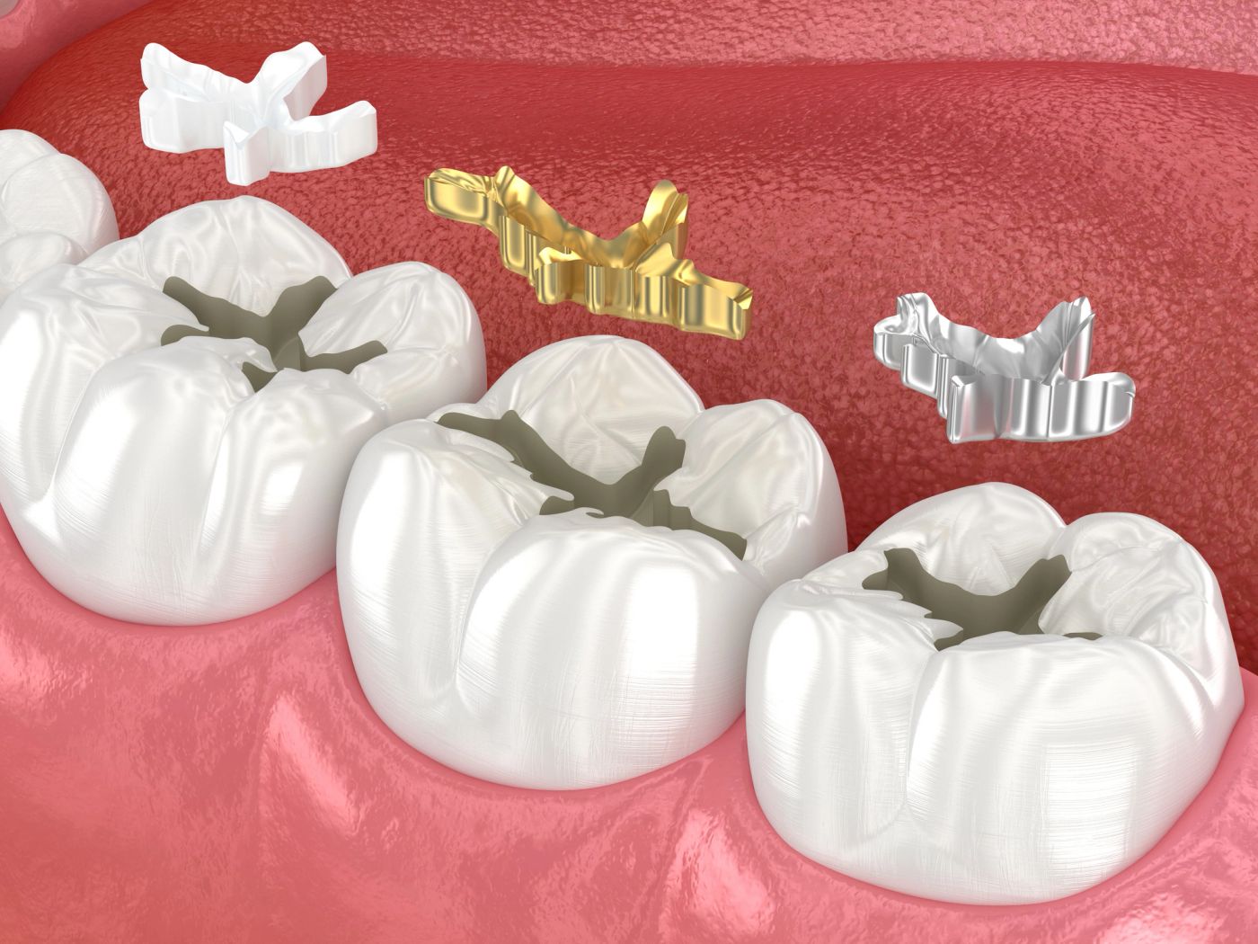 Tooth-Colored Fillings in Tysons Corner, VA