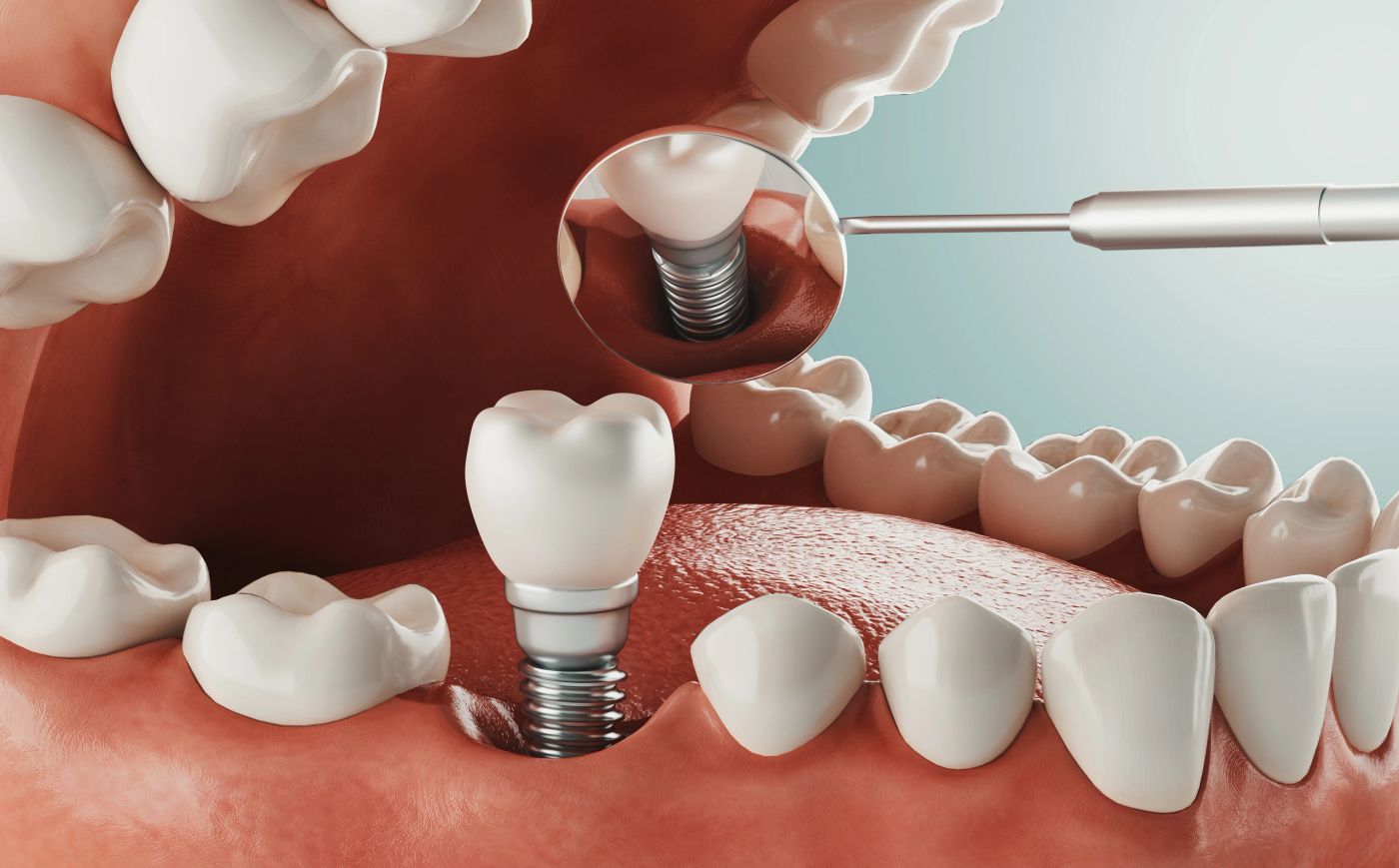 Dental Implants in Tysons Corner, VA