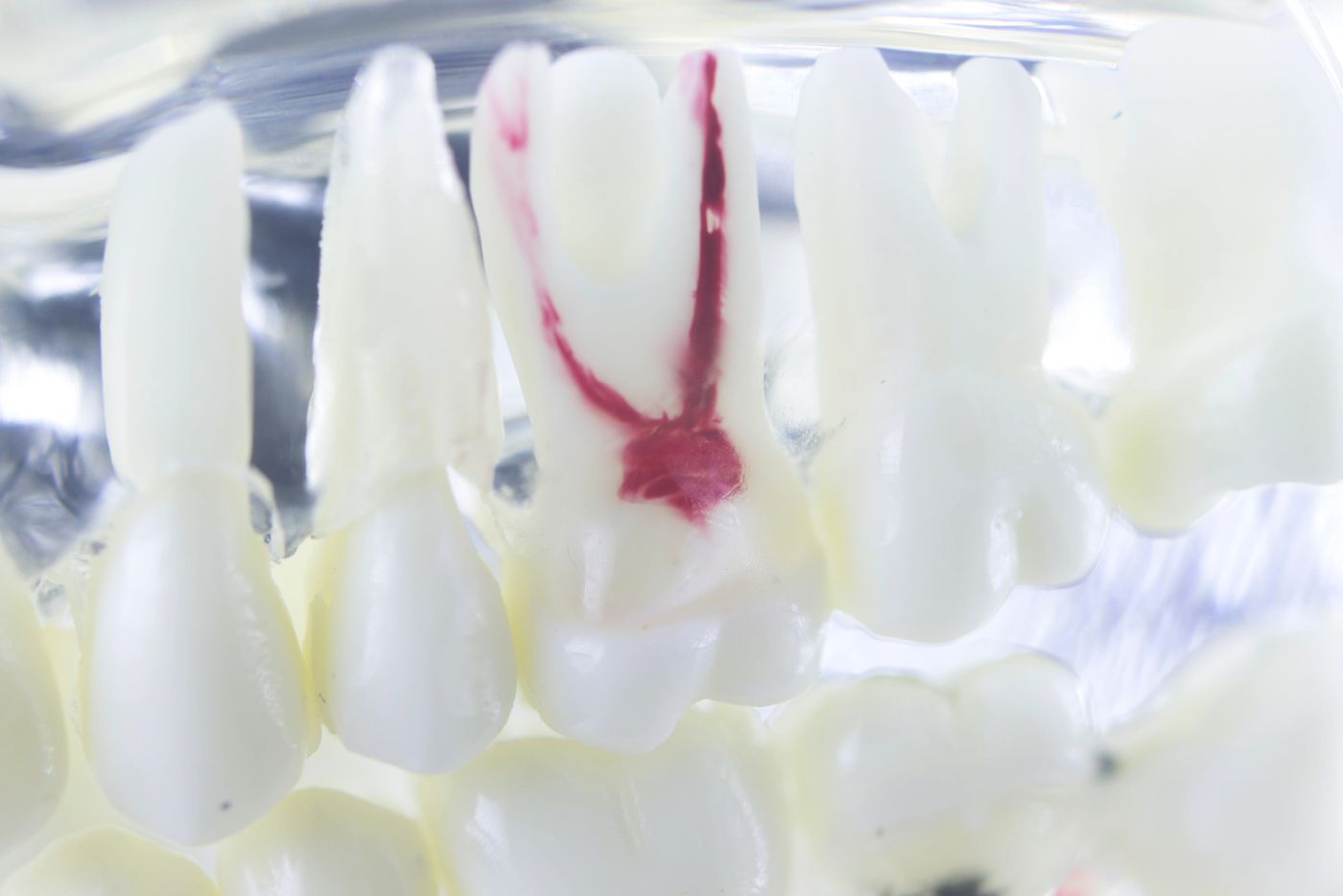 Root Canal Therapy in Tysons Corner, VA